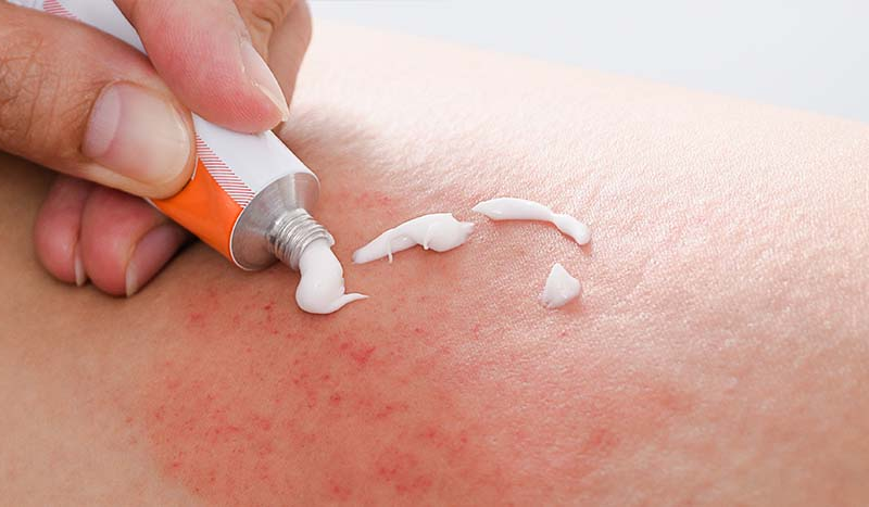 Understanding Topical Steroids for Eczema