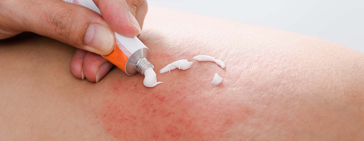 Understanding Topical Steroids for Eczema